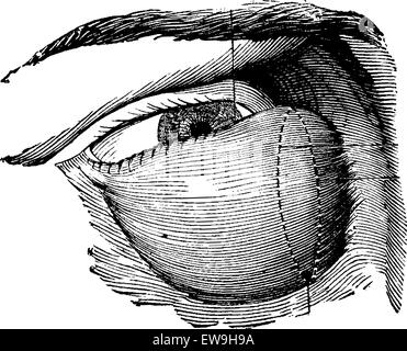 Tumeur lacrymale très développé, vintage engraved illustration. Dictionnaire de médecine habituelle par le Dr Labarthe - 1885 Illustration de Vecteur