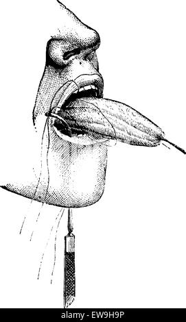 Amputation partielle de la langue à l'aide de ligatures, vintage engraved illustration. Dictionnaire de médecine habituelle par le Dr Labarthe - 1885 Illustration de Vecteur