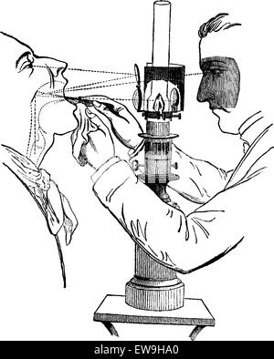 Laryngoscope, illuminé par la lumière directe du soleil, montrant un médecin regardant dans une bouche du patient, vintage engraved illustration. Us Illustration de Vecteur