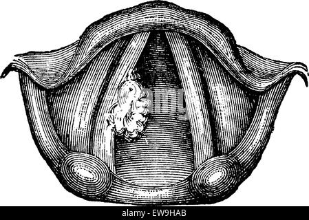 Papillome solitaire du larynx, vintage engraved illustration. Dictionnaire de médecine habituelle par le Dr Labarthe - 1885 Illustration de Vecteur