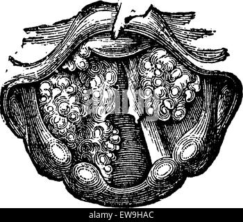 Plusieurs symptômes du larynx, vintage engraved illustration. Dictionnaire de médecine habituelle par le Dr Labarthe - 1885 Illustration de Vecteur