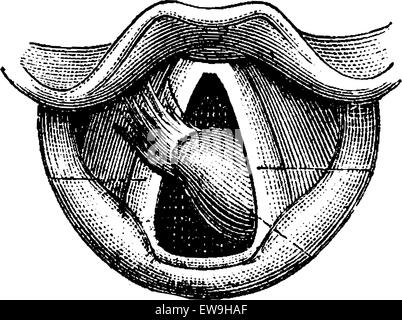 Les fibromes du larynx, vintage engraved illustration. Dictionnaire de médecine habituelle par le Dr Labarthe - 1885 Illustration de Vecteur