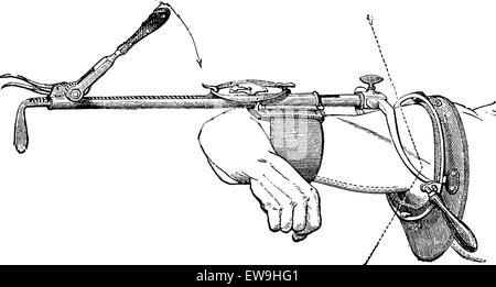 Appareil Charriere pour réduire les déplacements de l'épaule récents ou anciens, vintage engraved illustration. Dictionnaire de médecine habituelle Illustration de Vecteur