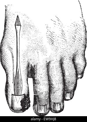 Fonctionnement de l'ongle incarne. Déchirer l'ongle, vintage engraved illustration. Dictionnaire de médecine habituelle - Paul Labarthe - 188 Illustration de Vecteur