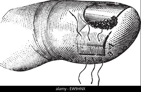 Fonctionnement de l'ongle incarne, vintage engraved illustration. Dictionnaire de médecine habituelle - Paul Labarthe - 1885. Illustration de Vecteur