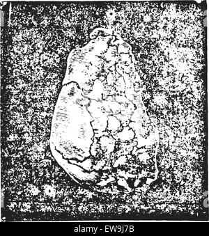Calcul de l'urate de sodium dans enchaton la muqueuse vésicale et extraites par prerectale taille (dans le profil), vintage engraved mauvais Illustration de Vecteur