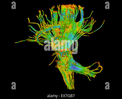 Tractographie des fibres de droit du cerveau humain Banque D'Images