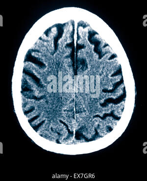 CT scan d'un vieil homme de 84 ans souffrant de la maladie d'Alzheimer. La TDM montre l'atrophie du cerveau. Banque D'Images