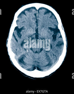 CT scan d'un vieil homme de 84 ans souffrant de la maladie d'Alzheimer. La TDM montre l'atrophie du cerveau. Banque D'Images