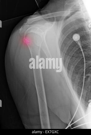 88 ans femme avec la fracture de l'humérus, et l'histoire de l'ostéoporose Banque D'Images