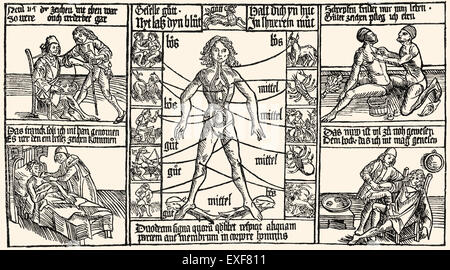 Procédure de traitement de la médecine, saignée, gravure sur bois, 1480, Banque D'Images