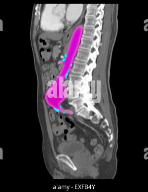 Angiographie abdominale tomodensitométrie, l'anévrisme de l'aorte. Les calcifications le long de l'aorte, les branches, les artères de l'athérosclérose Banque D'Images