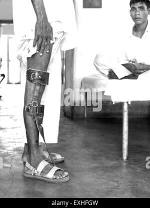Cette photographie montre un lépreux à Shantipur, en Inde, recevant des soins. L'image reflète les efforts humanitaires déployés pour soutenir les personnes touchées par la lèpre dans la région. Banque D'Images