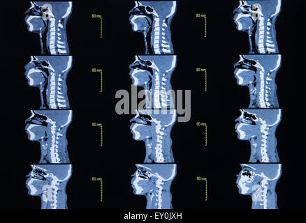 Série d'images d'une tomodensitométrie de l'orifice cervical (cou) Banque D'Images