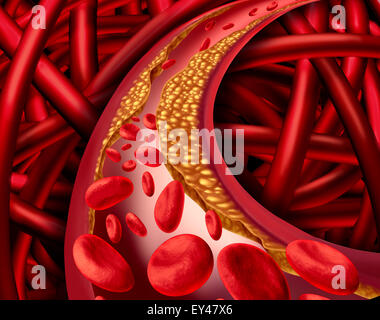 Problème d'artère avec blocage des artères et l'athérosclérose médicaux maladie concept avec un système cardio-vasculaire humain en trois dimensions avec des cellules du sang qui bloqué par l'accumulation de cholestérol comme un symbole des maladies vasculaires. Banque D'Images