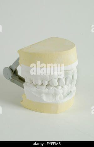 Une étude de distribution dentaire mâchoires supérieure et inférieure. La distribution est un élément positif à la reproduction des dents et des structures environnantes à des fins d'étude et de planification de traitement créé en versant pour permettre une impression en plâtre ou en pierre. Banque D'Images