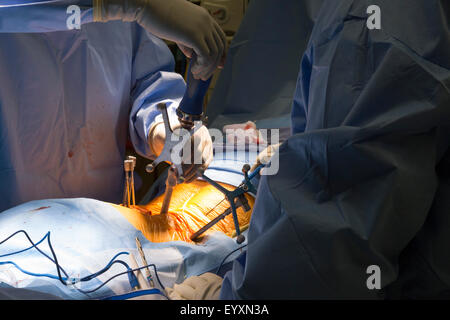 Englewood, Colorado - Le Dr Erik Parker effectue lombaire minimalement invasive fusion à instrumenté Swedish Medical Center. Banque D'Images