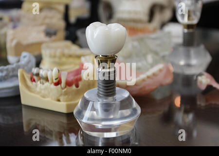 Dent géant sur le crystal stand avec des prothèses et des échantillons dentaires en arrière-plan Banque D'Images