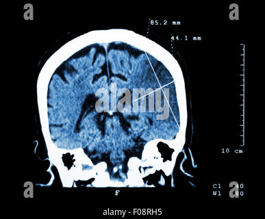 L'infarctus cérébral à l'hémisphère gauche ( ) de l'accident ischémique cérébral ( CT-scan du cerveau ) : La médecine et la science historique Banque D'Images