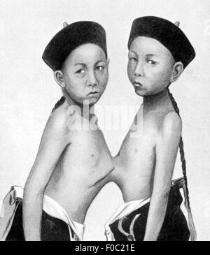 Médecine, anomalie, jumeaux siamois, twin-boys chinois, lithographie, 19e siècle, 19e siècle, graphique, graphique, Chine, demi-longueur, frère, sœur, frère, debout, tête, têtes, chapeau, casquettes, malformation, malformations congénitales, malformations, malformations, médicaments, anomalies, jumeaux, jumeaux, historique, historique, historique, historique, historique, enfants, enfants, sexe masculin, enfants, enfants non disponibles, enfants Banque D'Images