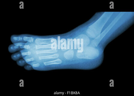 Film x-ray de pied de l'enfant ( ) Vue côté latéral ( ) Banque D'Images