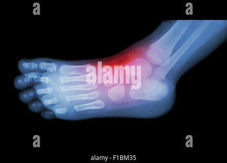 L'arthrite et les blessures à la cheville : film x-ray de pied de l'enfant ( ) Vue côté latéral ( ) Banque D'Images