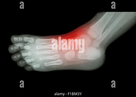 L'arthrite et les blessures à la cheville : film x-ray de pied de l'enfant ( ) Vue côté latéral ( ) Banque D'Images