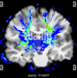 Vue coronale d'un cerveau humain dans la maladie de Parkinson. Mettre en évidence les zones bleu/vert fibres du système moteur Banque D'Images