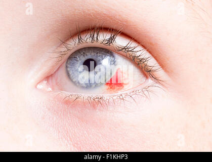 Close up d'un des yeux injectés de sang jusqu'à la les dommages causés par une blessure . Banque D'Images