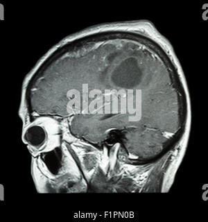 L'IRM cérébrale avec film de tumeur au cerveau ( plan sagittal , , Vue latérale Vue latérale ) ( Medical , soins de santé , Sciences ) Banque D'Images