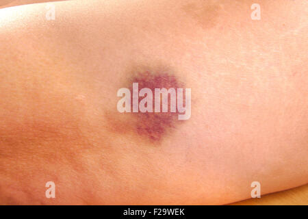 Close up d'un bleu sur la cuisse d'une femme Banque D'Images