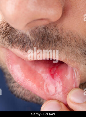 L'homme montre sa lèvre inférieure de la bouche avec aphtha Banque D'Images