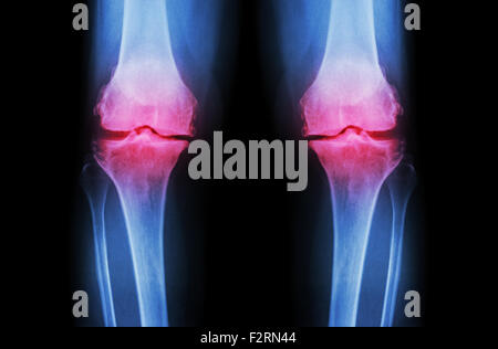 L'ARTHROSE DU GENOU Arthrose du genou ( ). Film x-ray deux genou ( vue avant ) show spatial commun étroit ( perte de cartilage ) , osteophy Banque D'Images