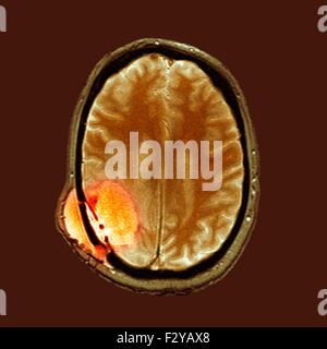 Après la chirurgie du cancer du cerveau. L'imagerie par résonance magnétique de couleur (IRM) d'une section à travers la tête d'un 59-year-old male patient de glioblastome multiforme, montrant une certaine amélioration de la maladie qui affecte la substance blanche après la chirurgie. Le glioblastome multiforme est une tumeur maligne (cancéreuse) qui résulte de l'un des astrocytes, cellules de soutien du cerveau. C'est un cancer agressif avec un mauvais pronostic. Ici, le cancer dans la cavité de l'articulation temporo-pariétal droit (en bas à droite) a largement amélioré. Banque D'Images