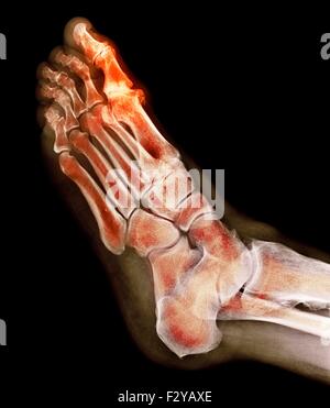 Déformation du pied dégénératives. X-ray de couleur d'une section à travers le pied d'un 66-year-old male patient souffrant d'une grave maladie dégénérative changement de l'articulation métatarsophalangienne (MTP) joint (en surbrillance) du gros orteil (haut). Les joints du PSG sont les articulations entre les métatarses du pied et la partie proximale de l'os (phalanges proximales) des orteils. Banque D'Images