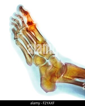 Déformation du pied dégénératives. X-ray de couleur d'une section à travers le pied d'un 66-year-old male patient souffrant d'une grave maladie dégénérative changement de l'articulation métatarsophalangienne (MTP) joint (en surbrillance) du gros orteil (haut). Les joints du PSG sont les articulations entre les métatarses du pied et la partie proximale de l'os (phalanges proximales) des orteils. Banque D'Images