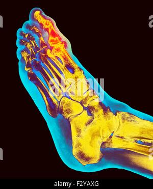 Déformation du pied dégénératives. X-ray de couleur d'une section à travers le pied d'un 66-year-old male patient souffrant d'une grave maladie dégénérative changement de l'articulation métatarsophalangienne (MTP) joint (en surbrillance) du gros orteil (haut). Les joints du PSG sont les articulations entre les métatarses du pied et la partie proximale de l'os (phalanges proximales) des orteils. Banque D'Images