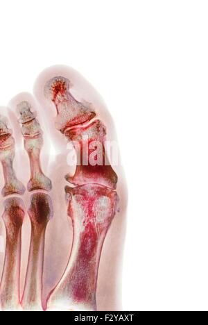 Déformation du pied dégénératives. X-ray de couleur d'une section à travers le pied d'un 66-year-old male patient souffrant d'une grave maladie dégénérative changement de l'articulation métatarsophalangienne (MTP) articulation du gros orteil (centre). Les joints du PSG sont les articulations entre les métatarses du pied et la partie proximale de l'os (phalanges proximales) des orteils. Banque D'Images