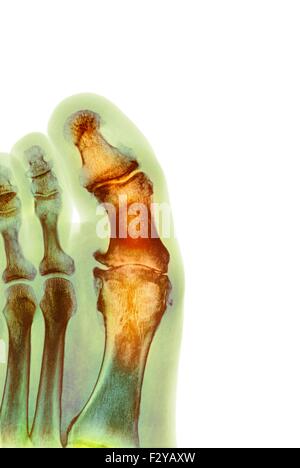 Déformation du pied dégénératives. X-ray de couleur d'une section à travers le pied d'un 66-year-old male patient souffrant d'une grave maladie dégénérative changement de l'articulation métatarsophalangienne (MTP) articulation du gros orteil (centre). Les joints du PSG sont les articulations entre les métatarses du pied et la partie proximale de l'os (phalanges proximales) des orteils. Banque D'Images