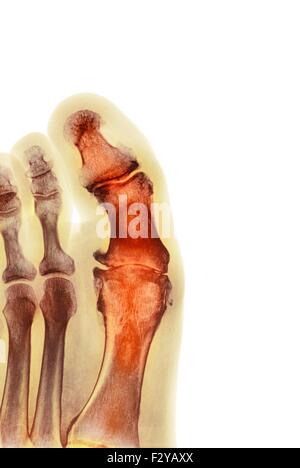 Déformation du pied dégénératives. X-ray de couleur d'une section à travers le pied d'un 66-year-old male patient souffrant d'une grave maladie dégénérative changement de l'articulation métatarsophalangienne (MTP) articulation du gros orteil (centre). Les joints du PSG sont les articulations entre les métatarses du pied et la partie proximale de l'os (phalanges proximales) des orteils. Banque D'Images