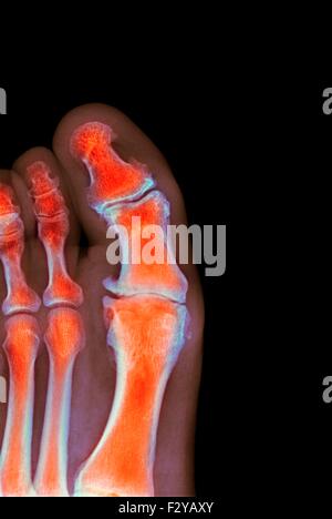 Déformation du pied dégénératives. X-ray de couleur d'une section à travers le pied d'un 66-year-old male patient souffrant d'une grave maladie dégénérative changement de l'articulation métatarsophalangienne (MTP) articulation du gros orteil (centre). Les joints du PSG sont les articulations entre les métatarses du pied et la partie proximale de l'os (phalanges proximales) des orteils. Banque D'Images