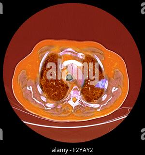 Le cancer du poumon. La tomographie de couleur (CT) d'une section à travers la poitrine d'un 76-year-old male patient avec une tumeur malignes (cancéreuses), lumineux (droite) de la bronche. Les bronches sont les voies aériennes qui transportent l'air aux poumons et de la bouche. Banque D'Images