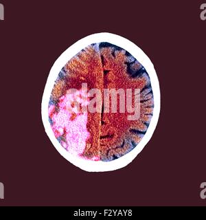 Dans le cerveau d'un AVC. L'imagerie par résonance magnétique (IRM) d'une section axiale dans le cerveau d'un 80-year-old male patient après un AVC. Un accident vasculaire cérébral, ou un accident vasculaire cérébral (AVC), est la perte rapide de la fonction cérébrale due à une perturbation dans l'approvisionnement en sang du cerveau. L'accident ischémique cérébral est causé par une réduction de l'approvisionnement de sang à une zone du cerveau. Banque D'Images