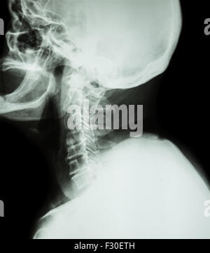 La spondylose cervicale . Film x-ray du rachis cervical ( position latérale, côté ) ( voir ) Banque D'Images