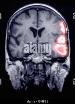 Temporoparietal hémorragie cérébrale dans une femme de 77 ans indiqué sur une IRM Banque D'Images