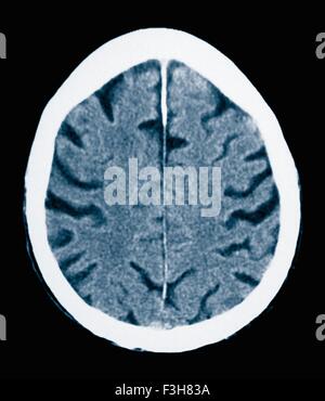 CT scan 84 ans homme à la maladie d'Alzheimer. La TDM montre l'atrophie du cerveau avec de petites et grandes circonvolutions sulci Banque D'Images