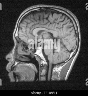 L'IRM de la tête montrant les structures normales du cerveau Banque D'Images