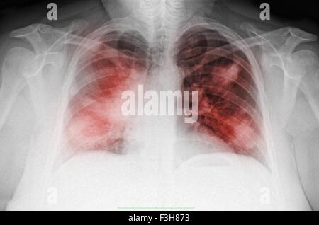 Radiographie d'une femme de 44 ans, fumeur PA vue, montrant des infiltrats interstitiels diffus évocateurs d'une pneumonie atypique Banque D'Images