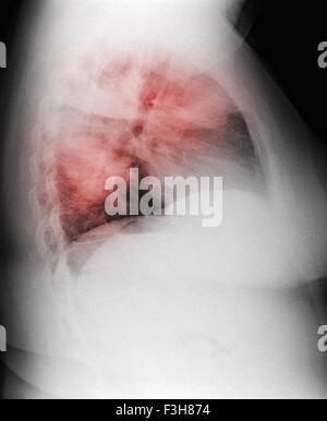 Radiographie des poumons d'un fumeur femme de 44 ans, montrant des infiltrats interstitiels diffus évocateurs d'une pneumonie atypique Banque D'Images