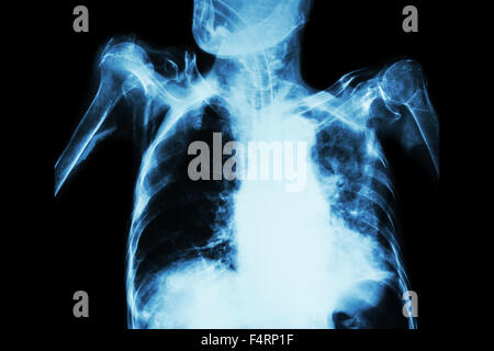 La tuberculose pulmonaire avec insuffisance respiratoire aiguë ( Film radiographie pulmonaire de l'ancien show patient interstitielle et alvéolaire infiltrat Banque D'Images